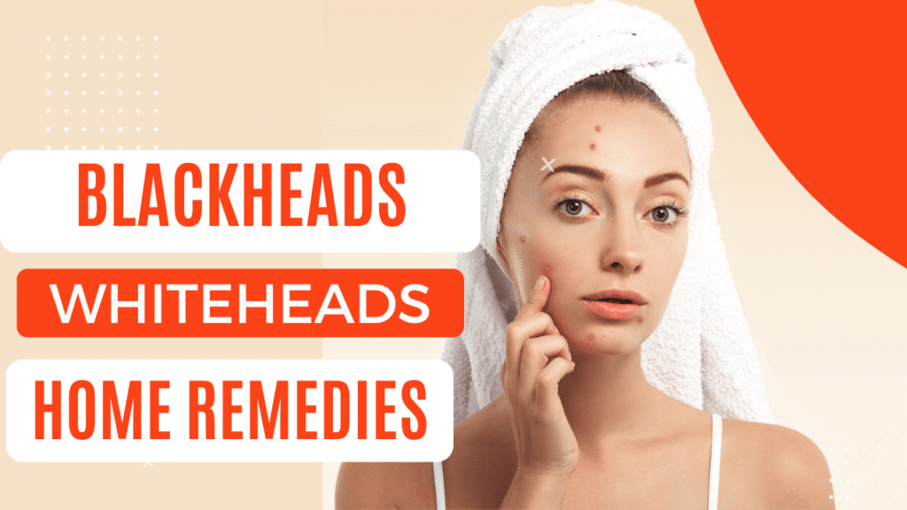 Blackheads Whiteheads Home Remedies